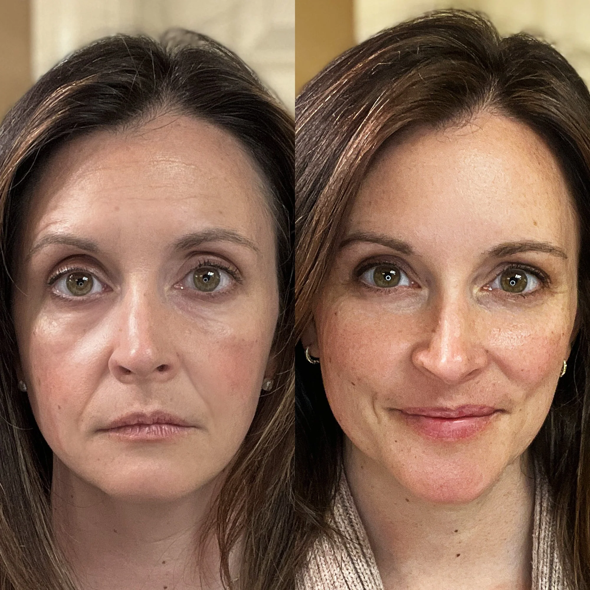 Light Therapy® Device Prelander - Image 3