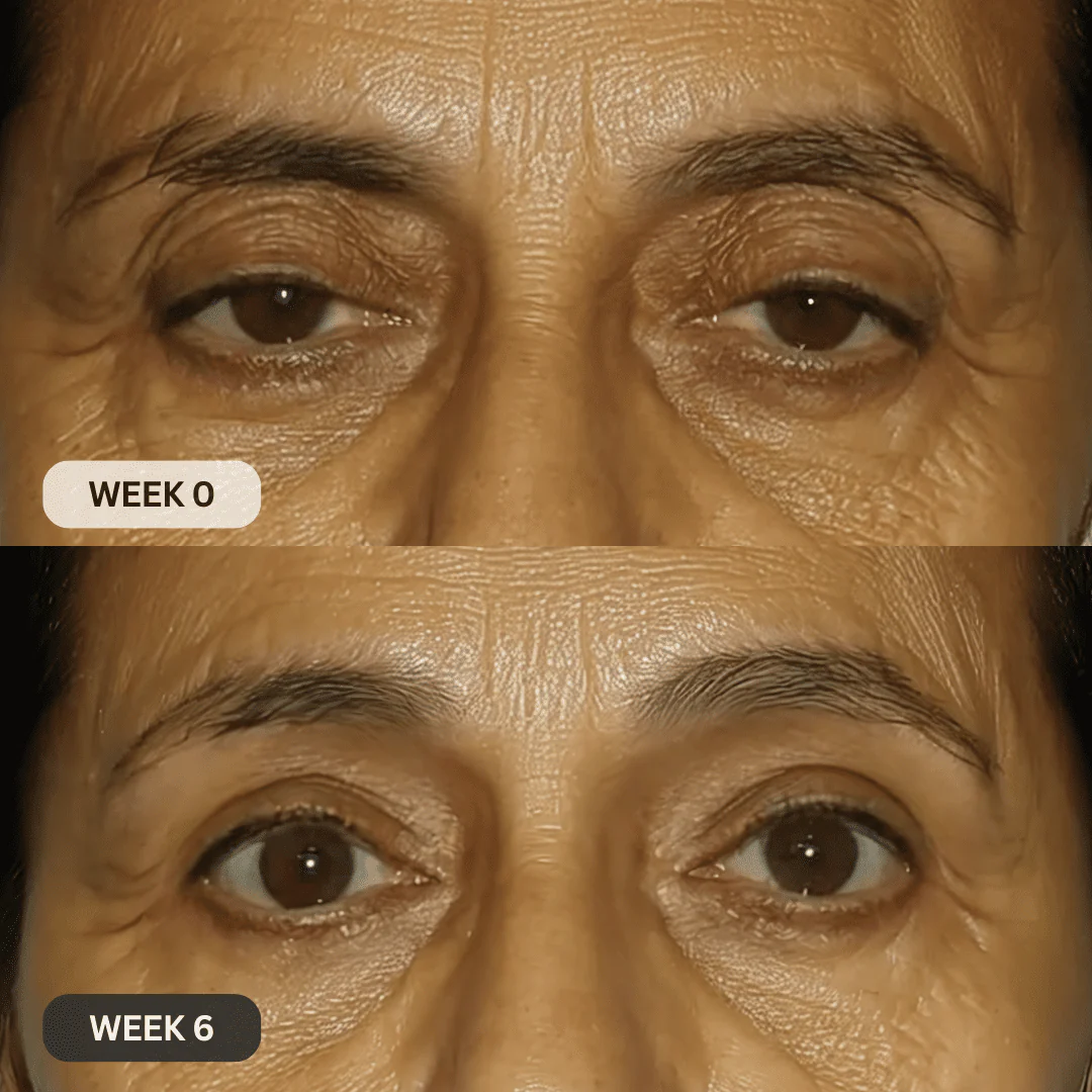 Micro-Infusion System For Hooded Eyelids - Image 10