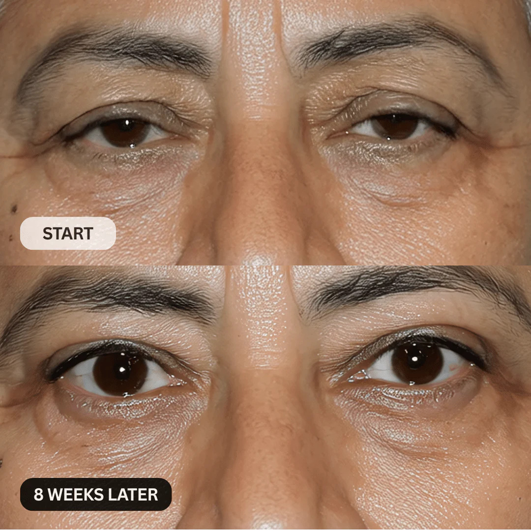 Micro-Infusion System For Hooded Eyelids - Image 12