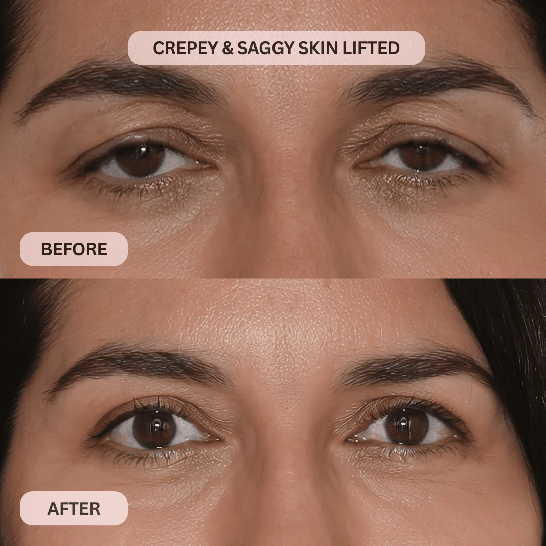 Micro-Infusion System For Hooded Eyelids - Image 5