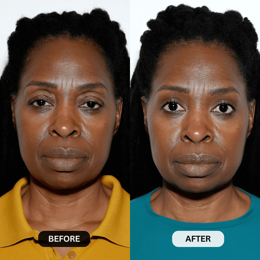 Micro-Infusion System For Hooded Eyelids - Image 7
