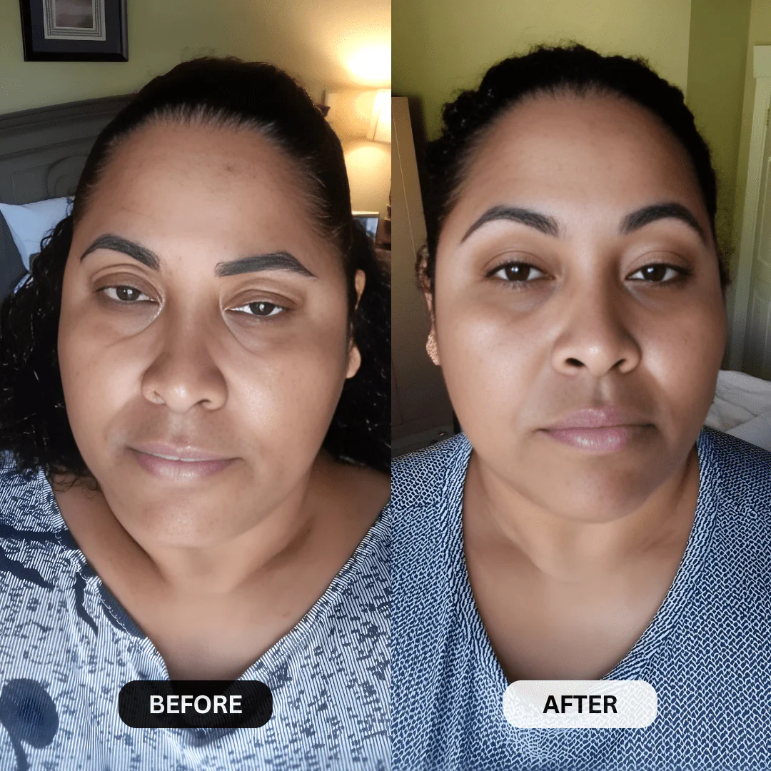 Micro-Infusion System For Hooded Eyelids - Image 9