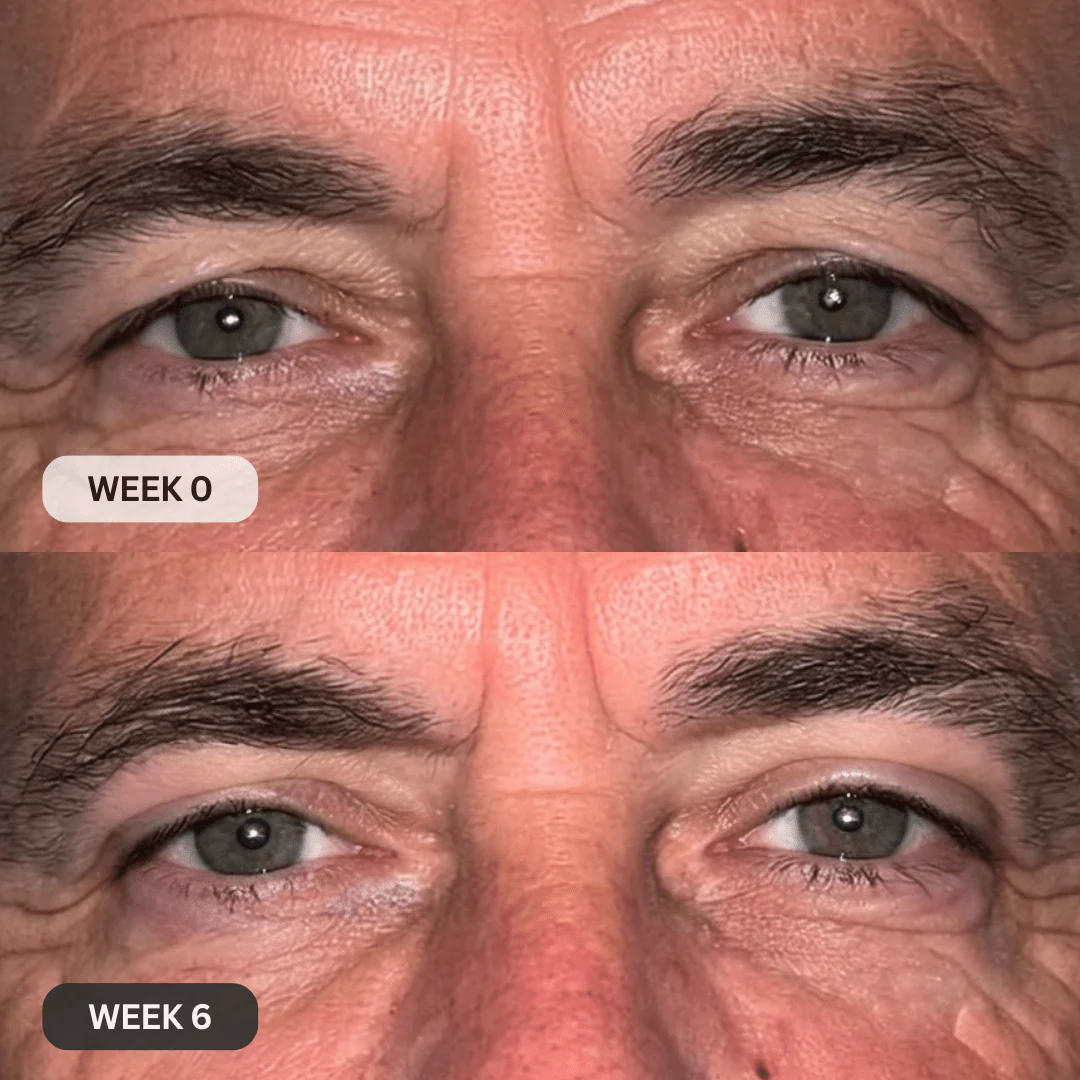 Micro-Infusion System For Hooded Eyelids for Men - Image 10
