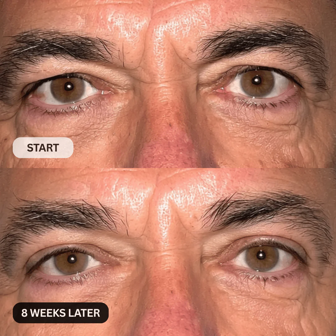 Micro-Infusion System For Hooded Eyelids for Men - Image 11