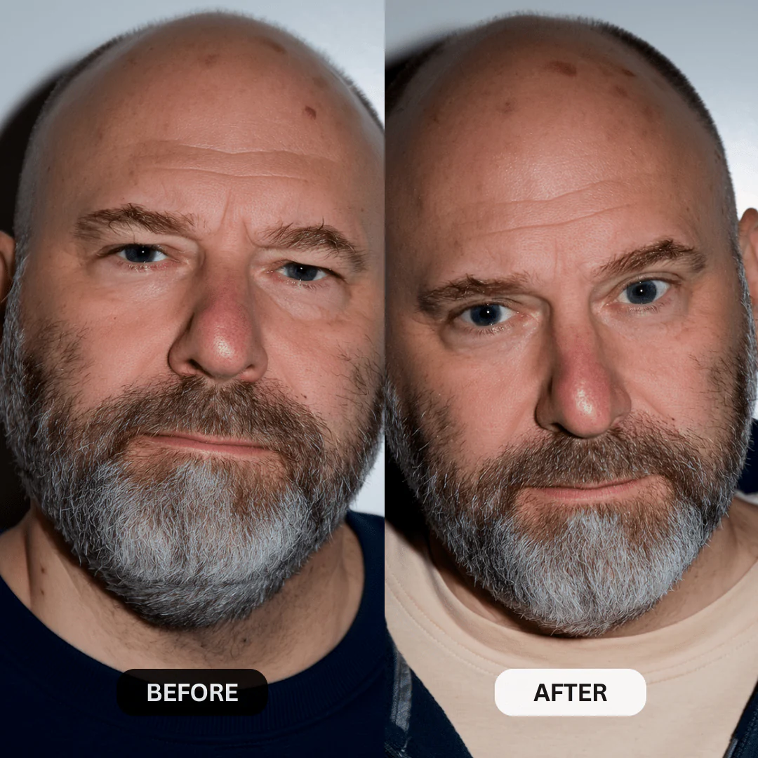 Micro-Infusion System For Hooded Eyelids for Men - Image 6