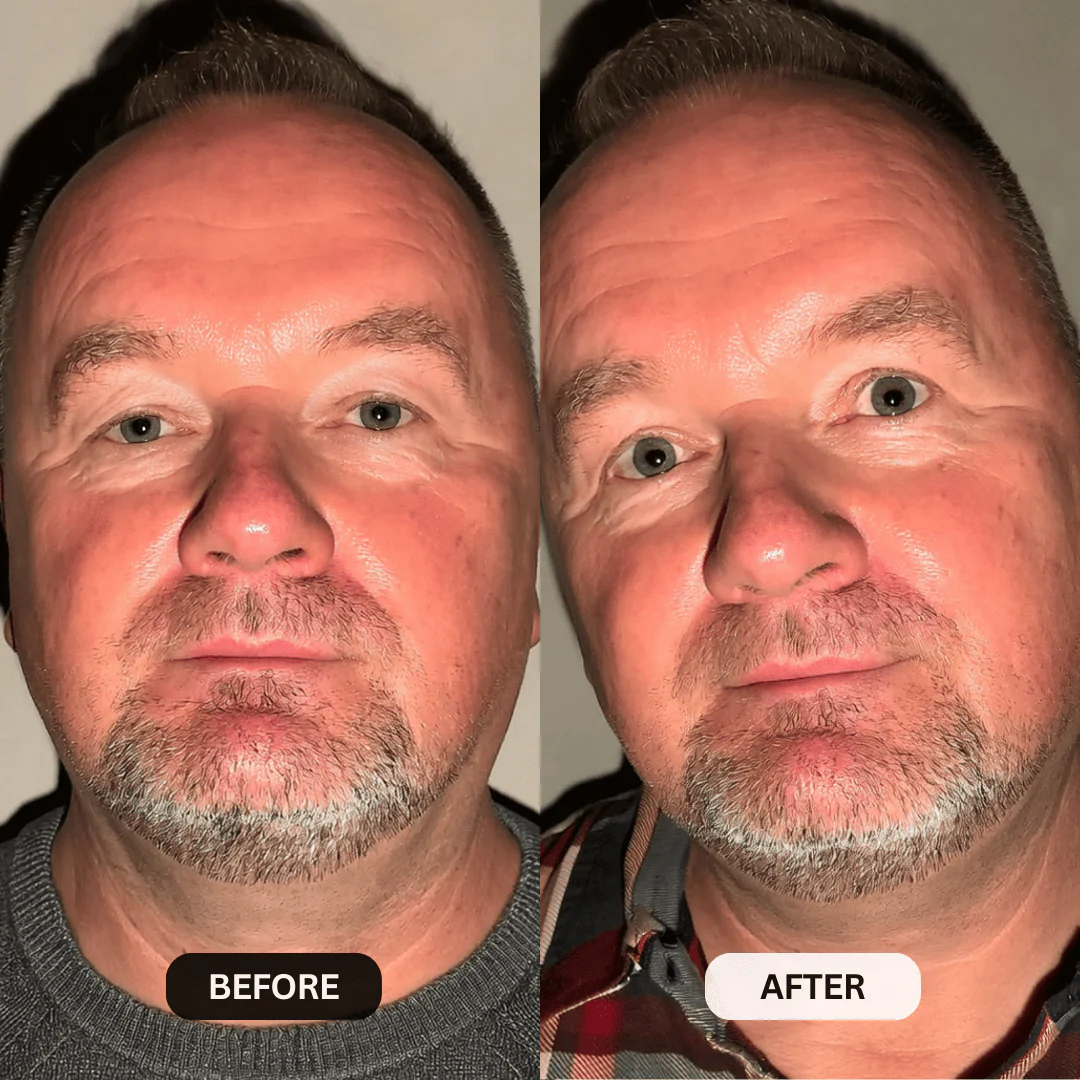 Micro-Infusion System For Hooded Eyelids for Men - Image 9