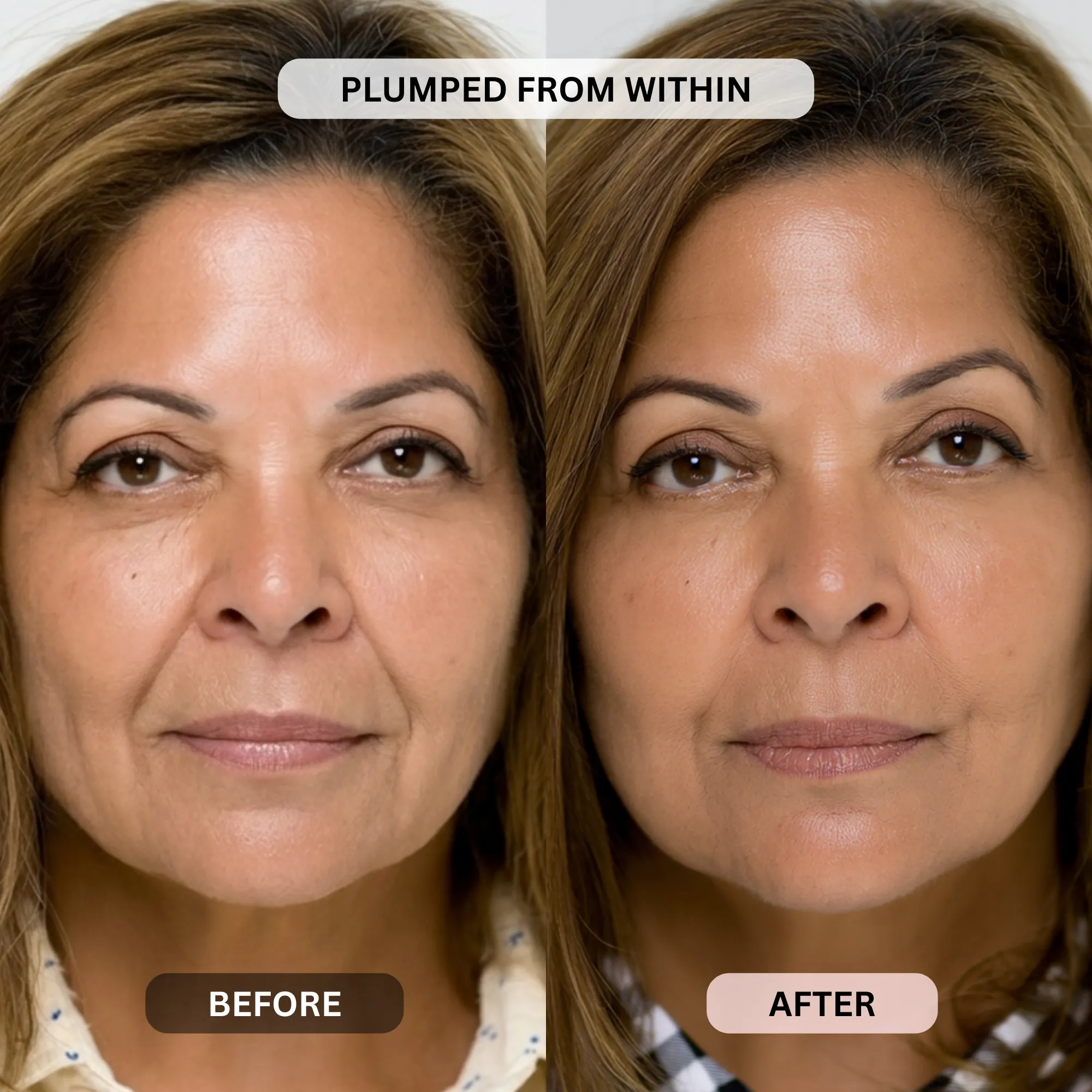 Micro-Infusion System For Smile Lines - Image 10