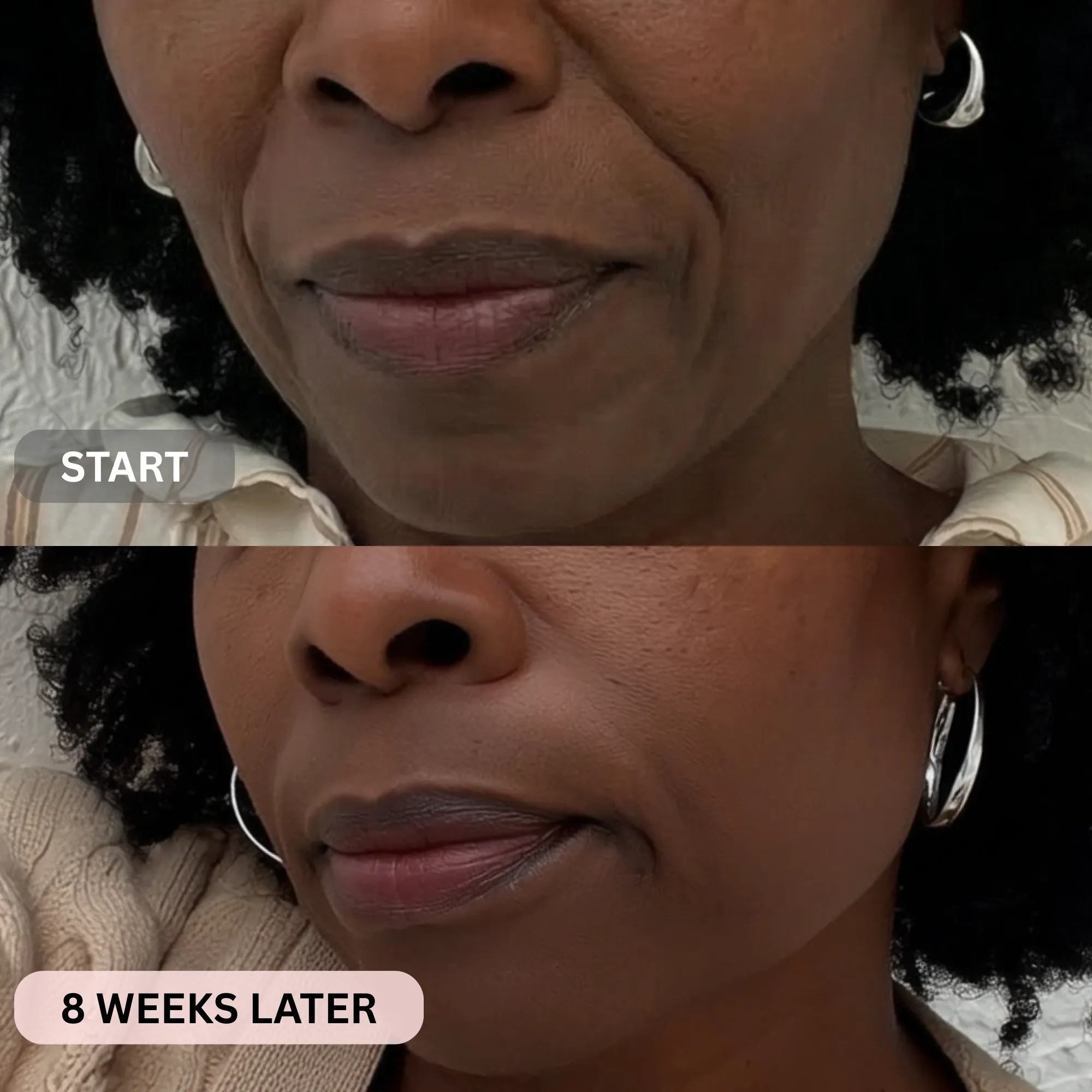 Micro-Infusion System For Smile Lines - Image 11