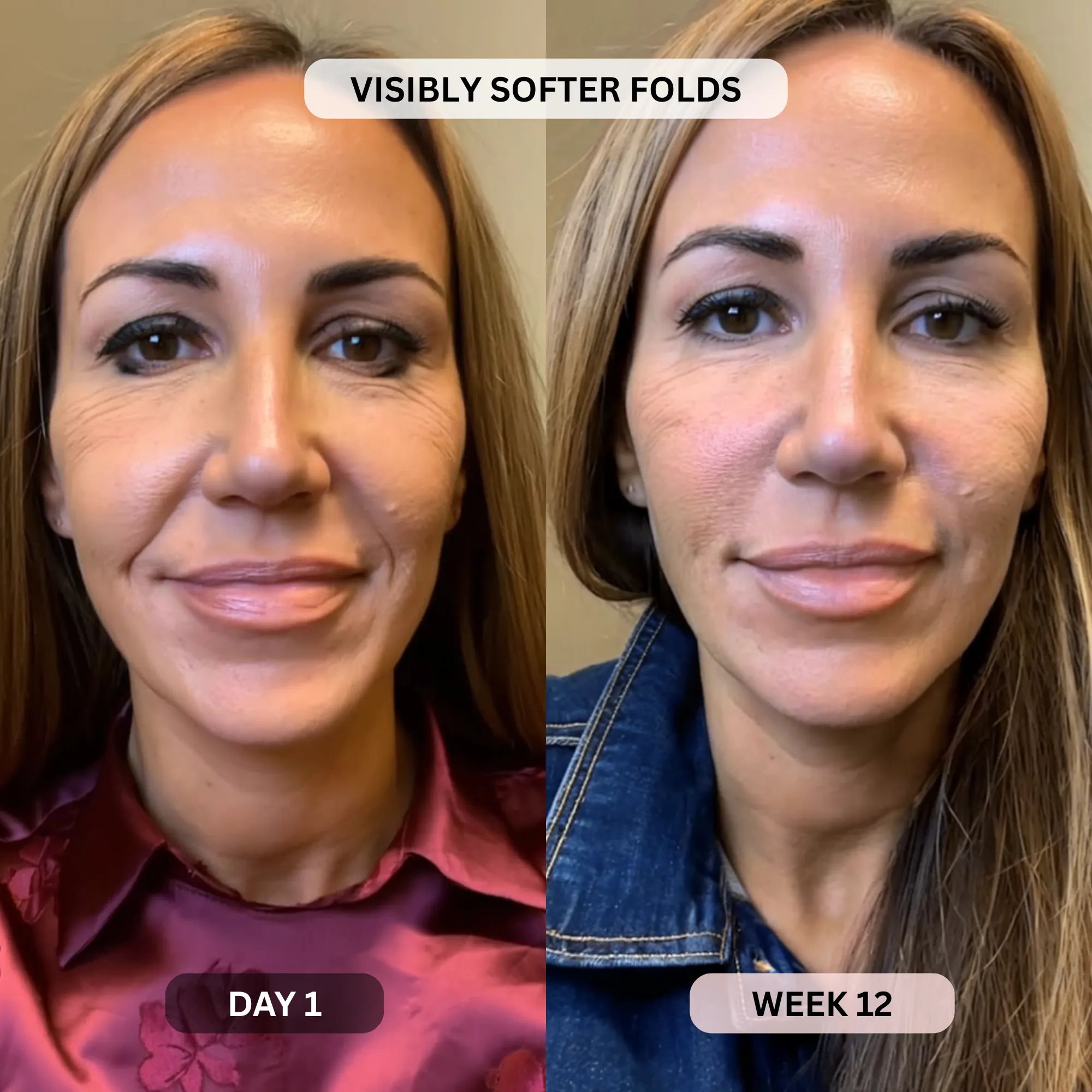 Micro-Infusion System For Smile Lines - Image 13