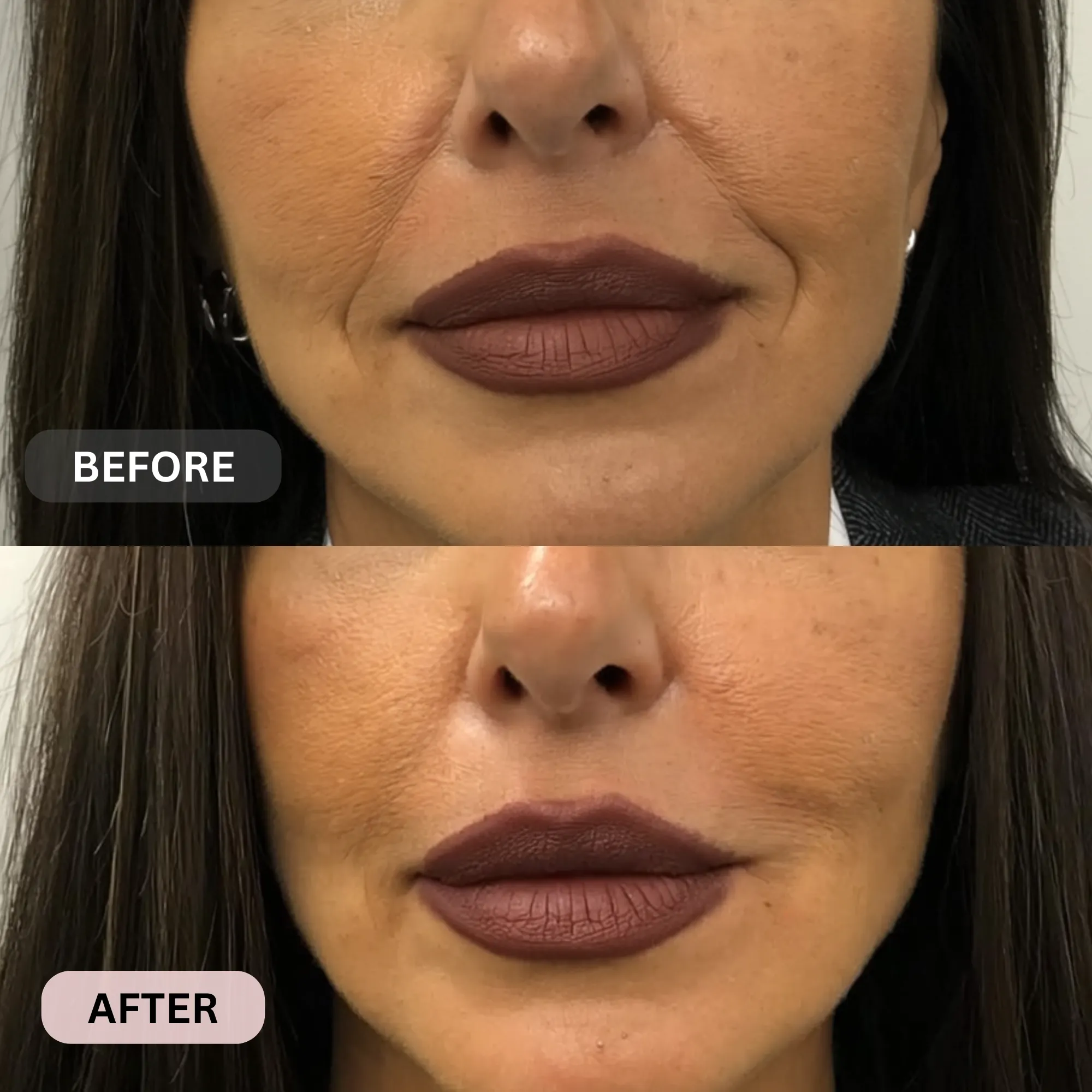 Micro-Infusion System For Smile Lines - Image 14