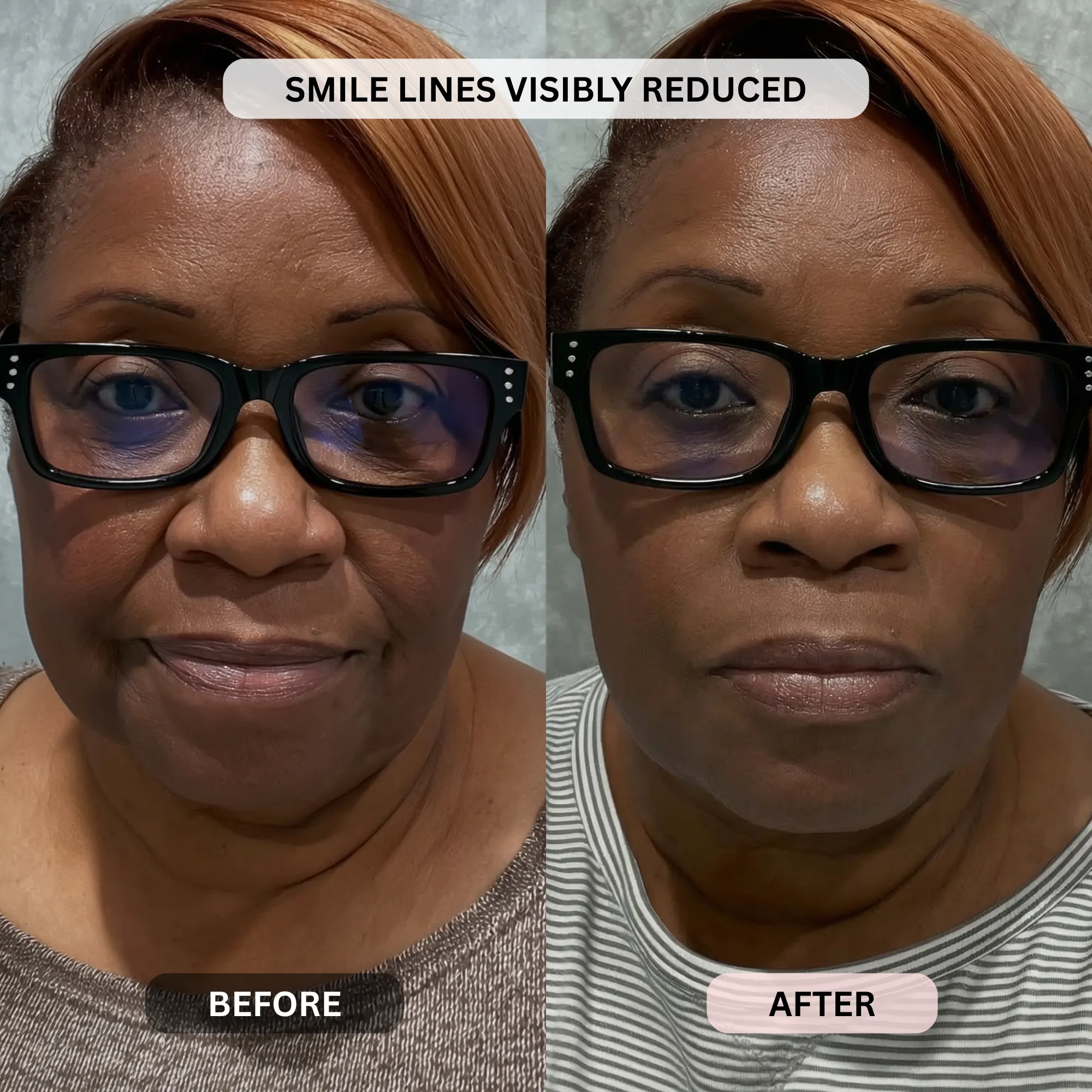 Micro-Infusion System For Smile Lines - Image 15