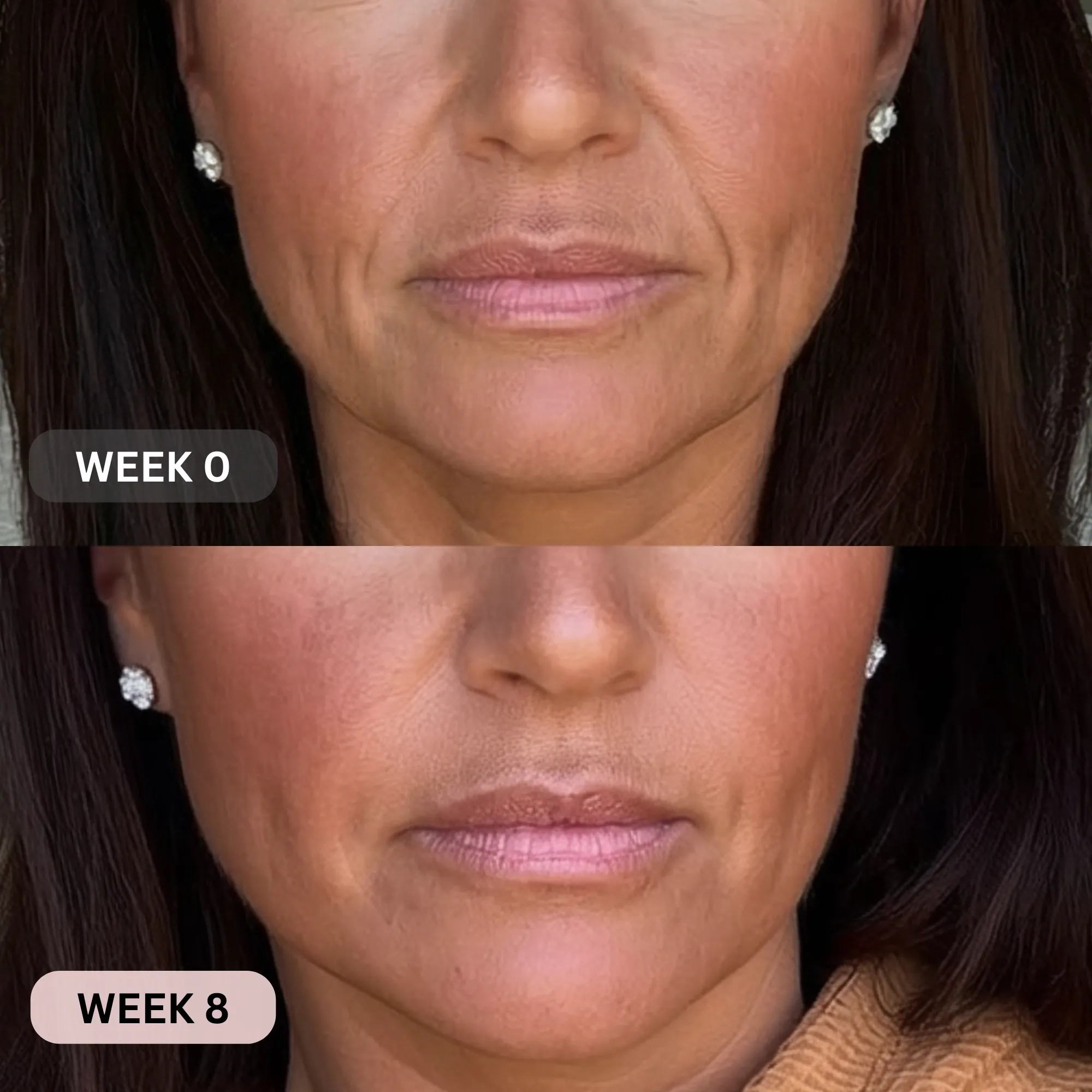 Micro-Infusion System For Smile Lines - Image 16