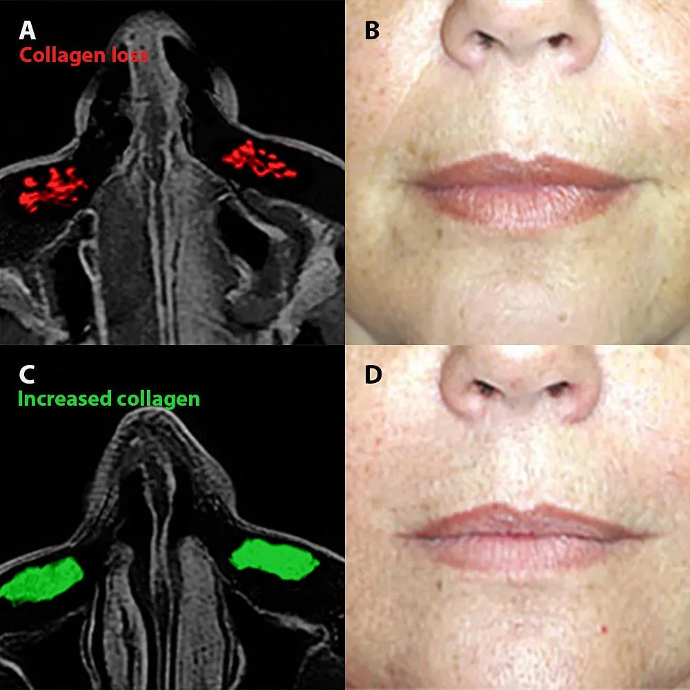 Micro-Infusion System For Smile Lines - Image 3
