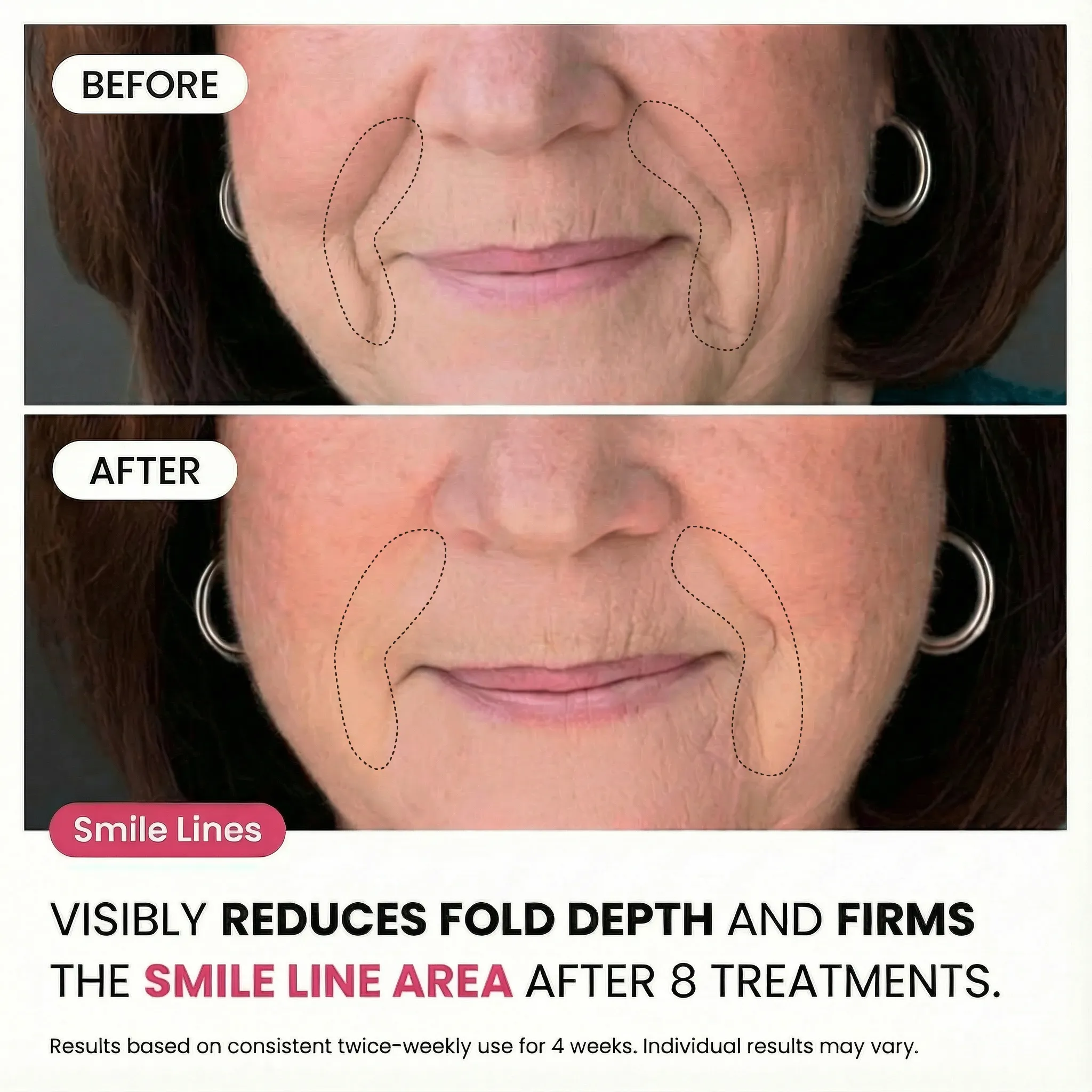 Micro-Infusion System For Smile Lines - Image 4