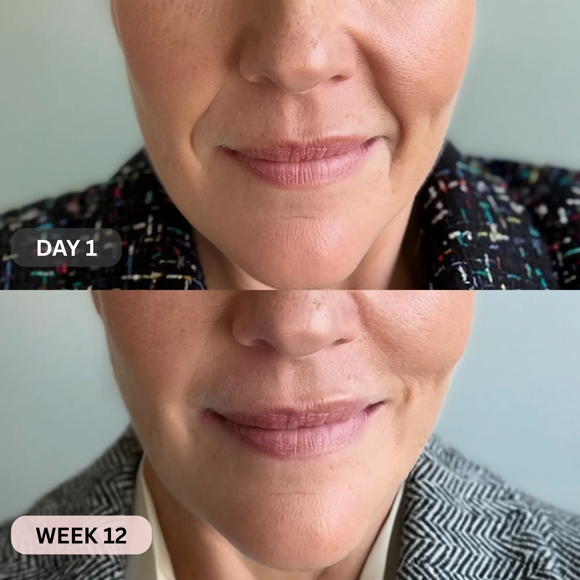Micro-Infusion System For Smile Lines - Image 8