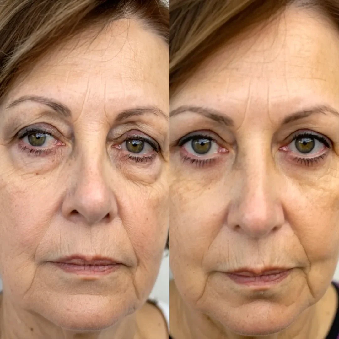 RevitalEyes® 2-in-1 Red Light Therapy + EMS To Erase Eye Bags - Image 3