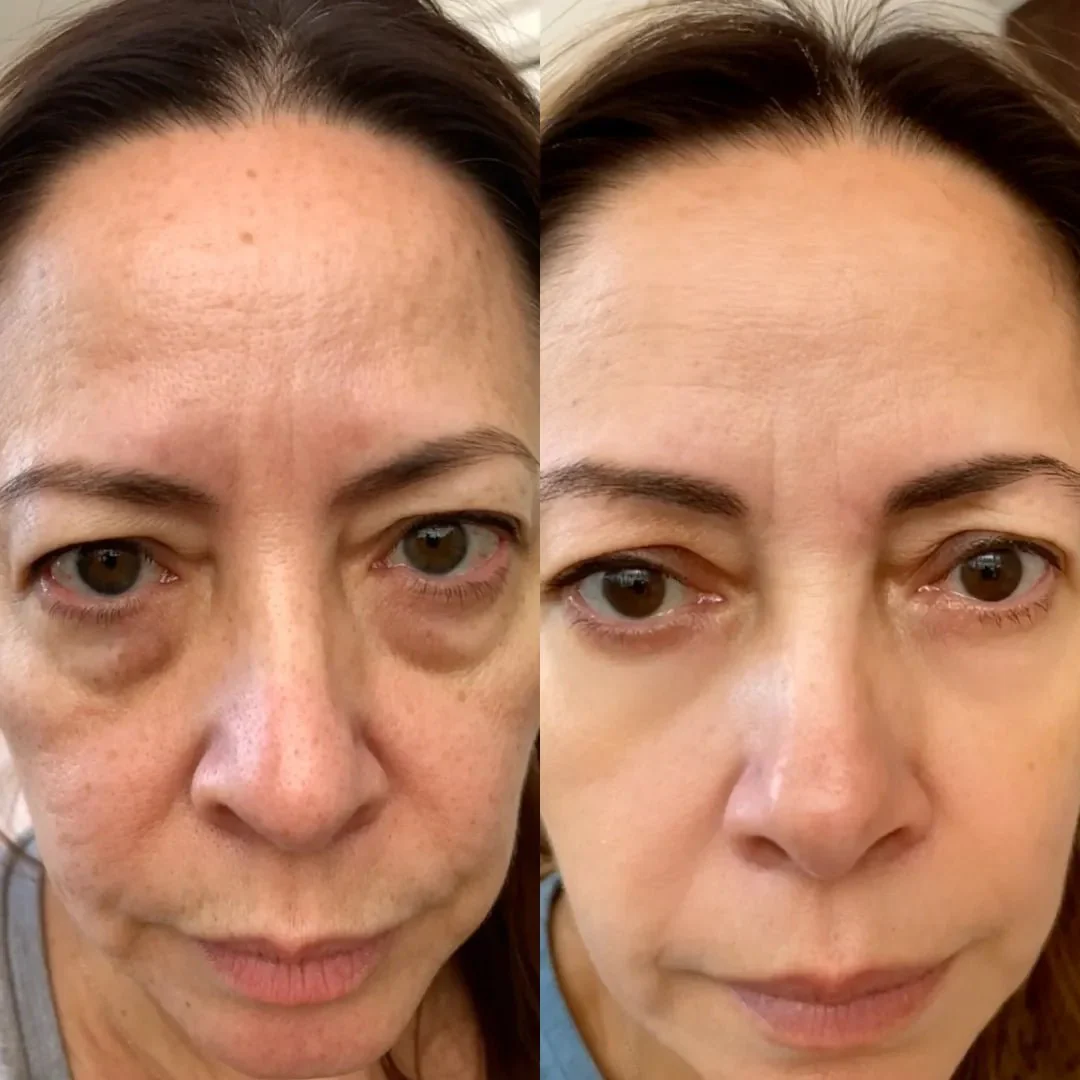 RevitalEyes® 2-in-1 Red Light Therapy + EMS To Erase Eye Bags - Image 4
