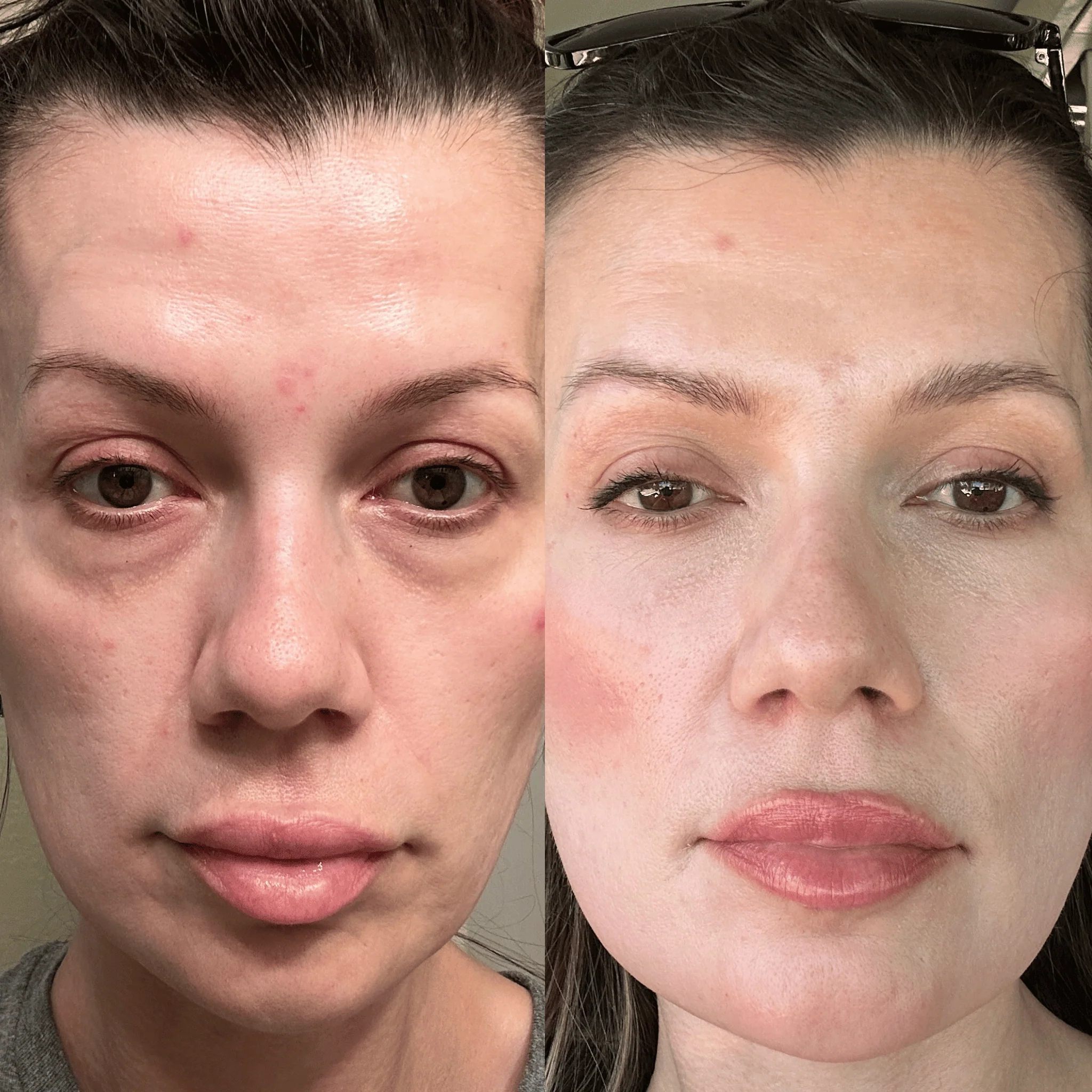RevitalEyes®  2-in-1 Red Light + EMS Under-Eye Therapy - Image 3