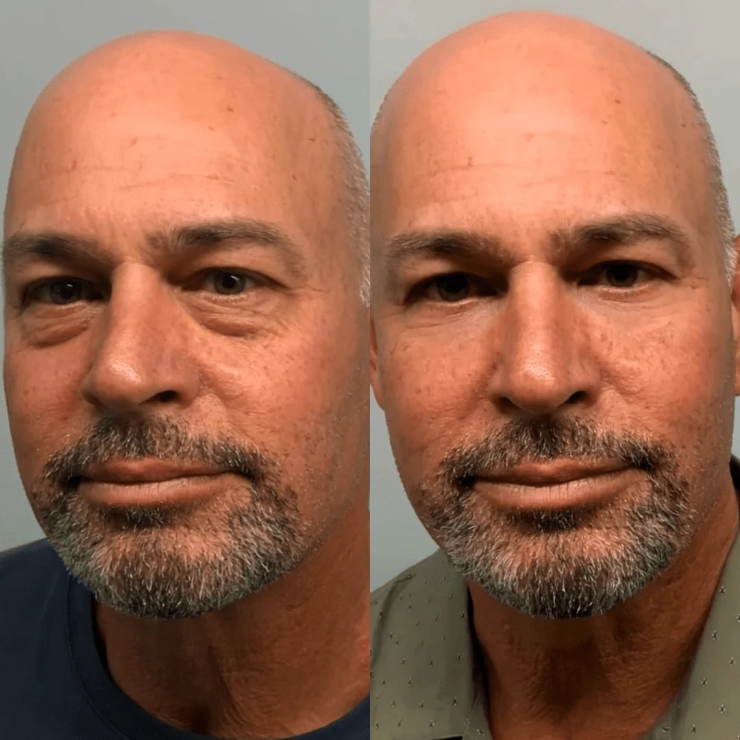 RevitalEyes® 2-in-1 Red Light Therapy + EMS To Erase Eye Bags for Men - Image 3