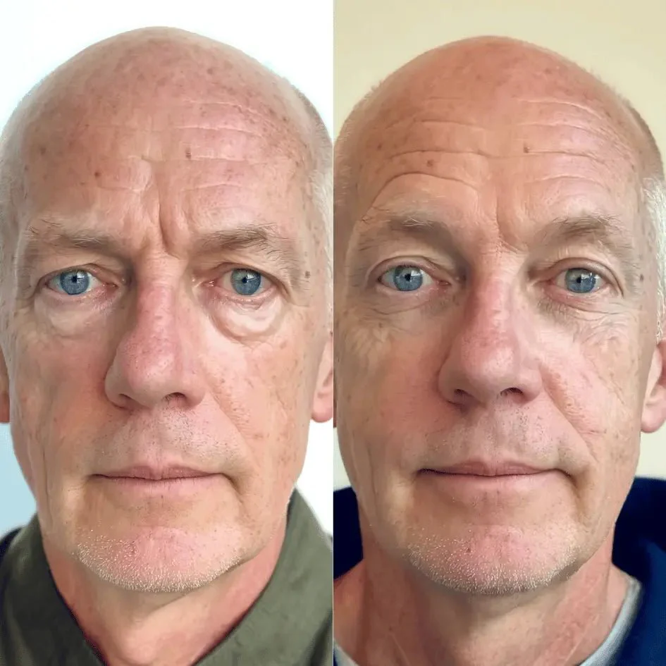 RevitalEyes® 2-in-1 Red Light Therapy + EMS To Erase Eye Bags for Men - Image 5