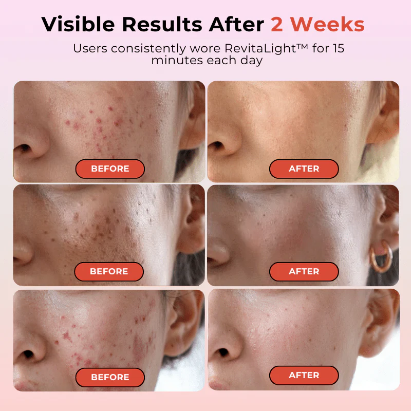 RevitaLight™ Red Light Therapy Face Mask - Image 4